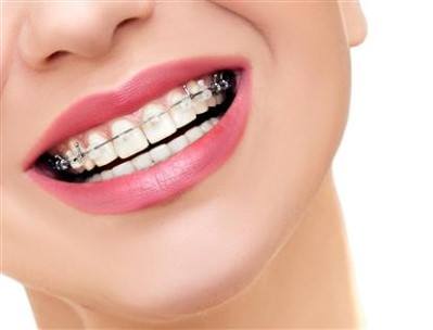 5 Dental Conditions Braces Are Most Effective for Treating