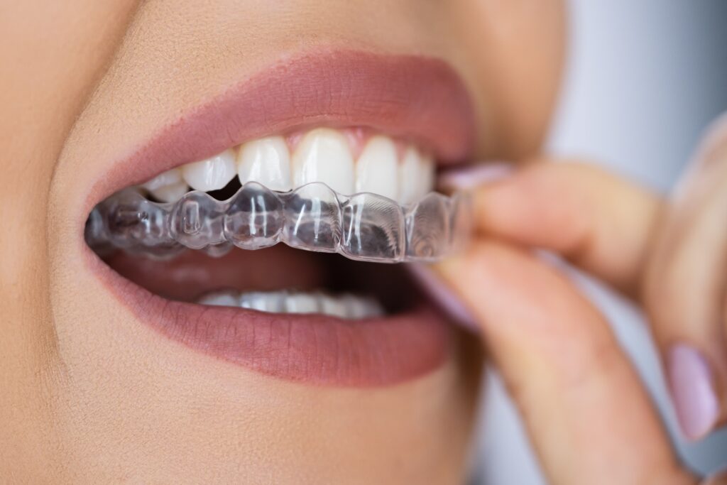 A woman with lipstick inserting Invisalign