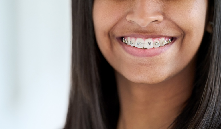 Close up of a teen with braces smiling