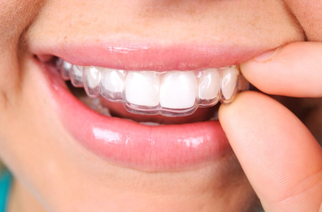 Close up of the mouth of a woman smiling while adjusting her Invisalign aligner with her thumb and forefinger